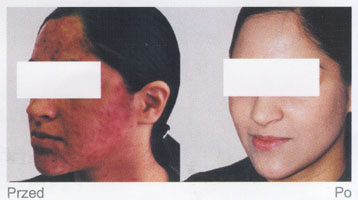 twarz przed i po bio-peelingu