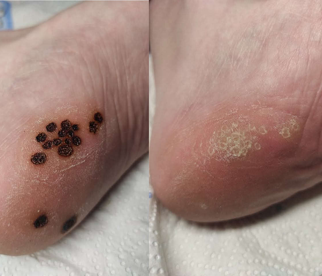 leczenie brodawek w Gabinecie Kosmetyczno - Podologicznym Maria
            w Gnieźnie