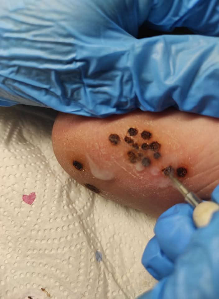 zabieg elektrokoagulacji w Gabinecie Kosmetyczno - Podologicznym Maria
            w Gnieźnie